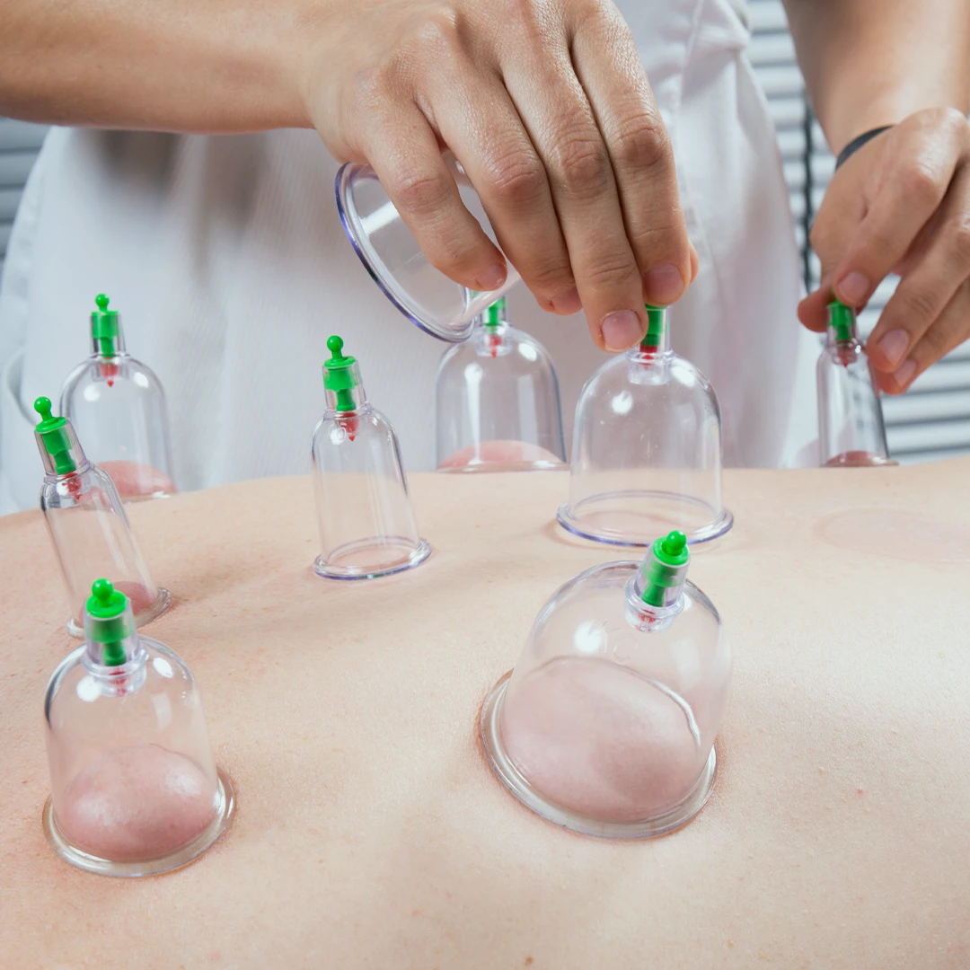 Therapeutic cupping services provided by PhysioEdge PT