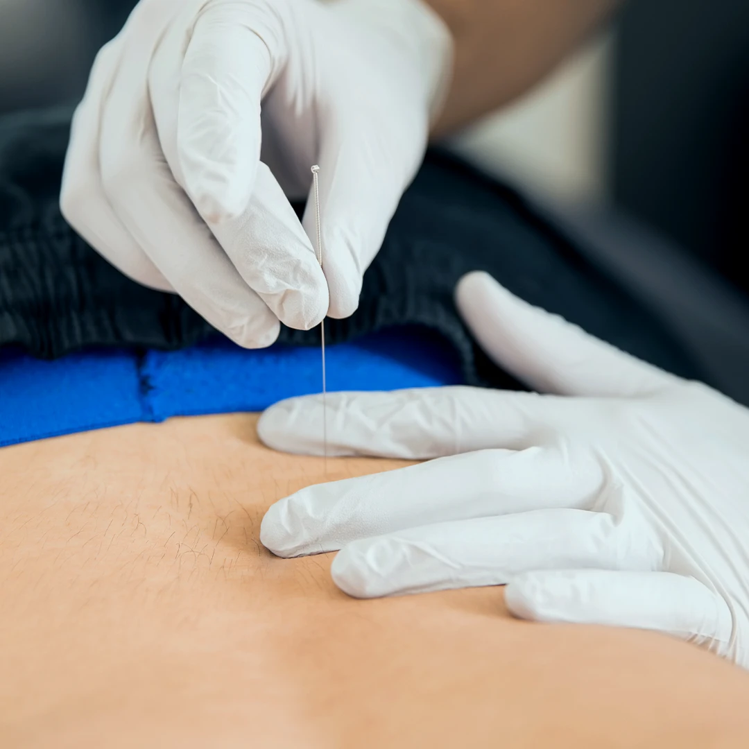 Dry needling services