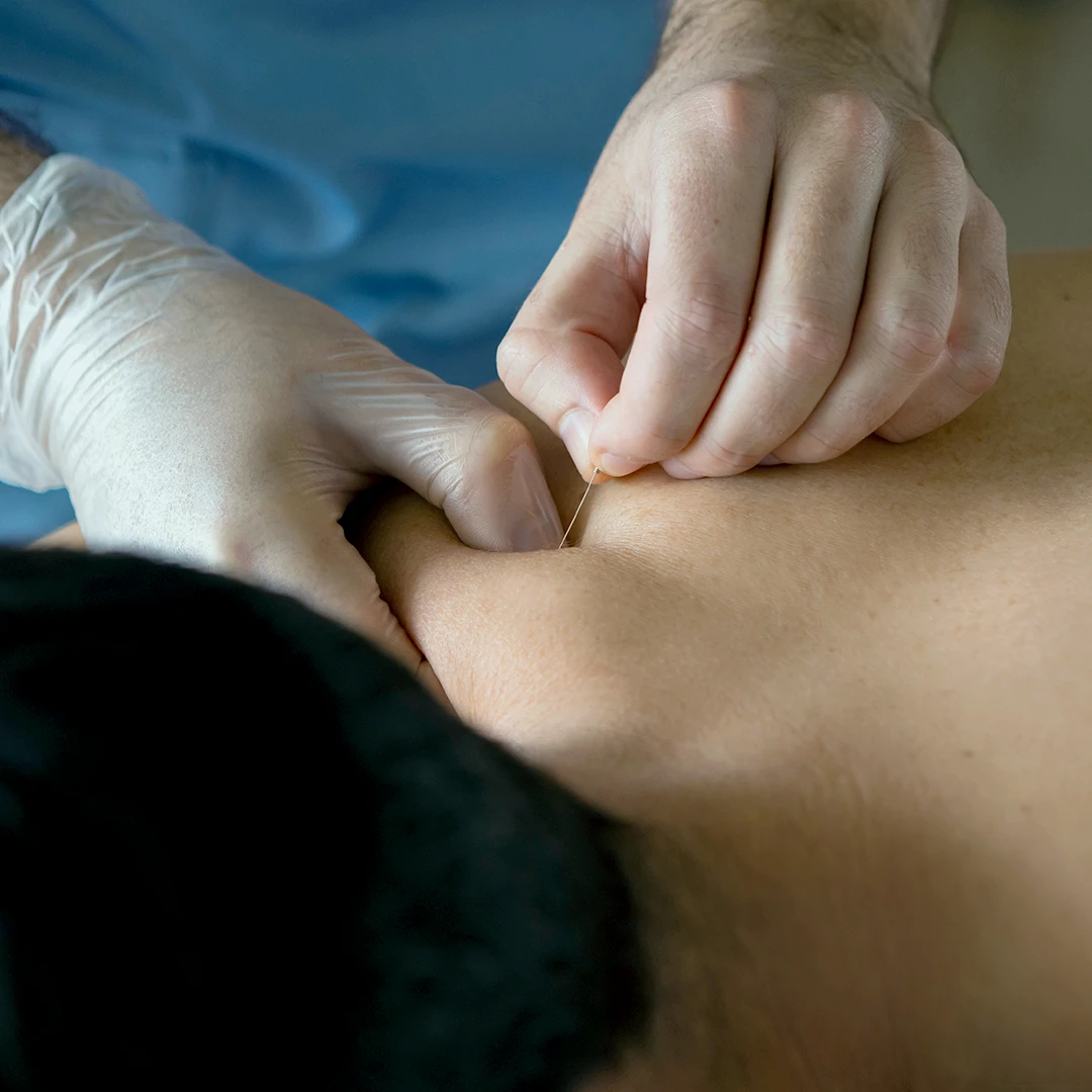 Benefits of dry needling services